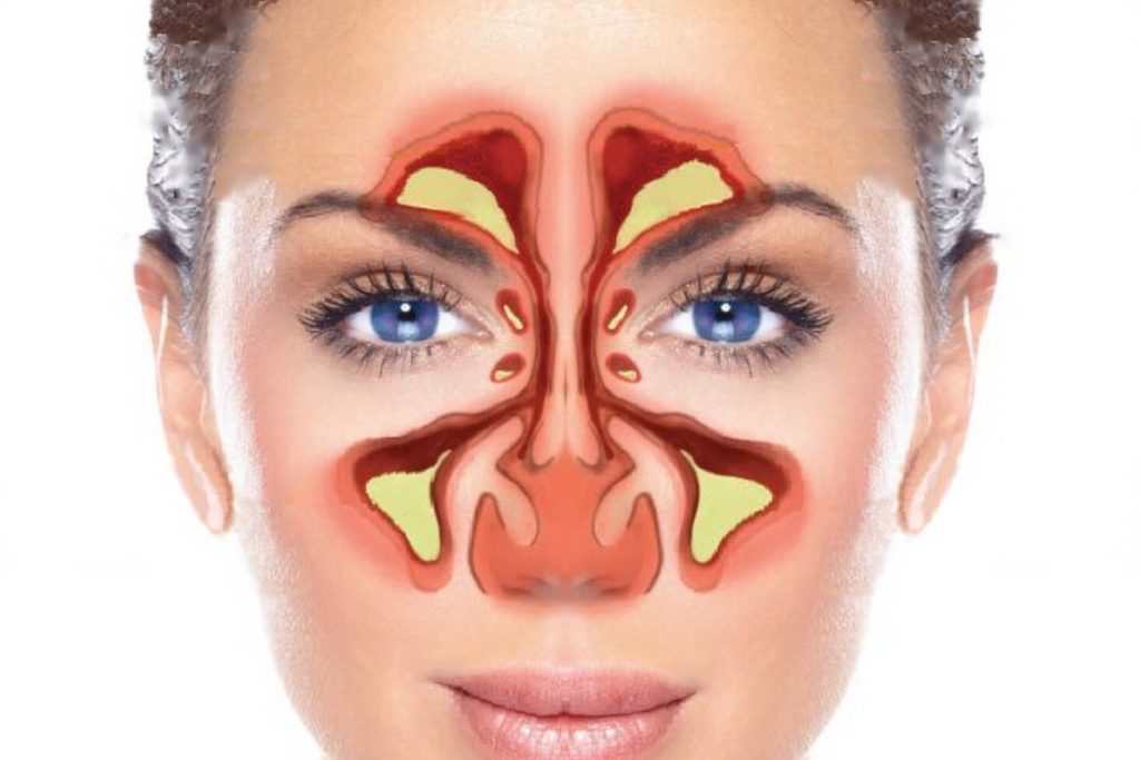 Sinus Headaches