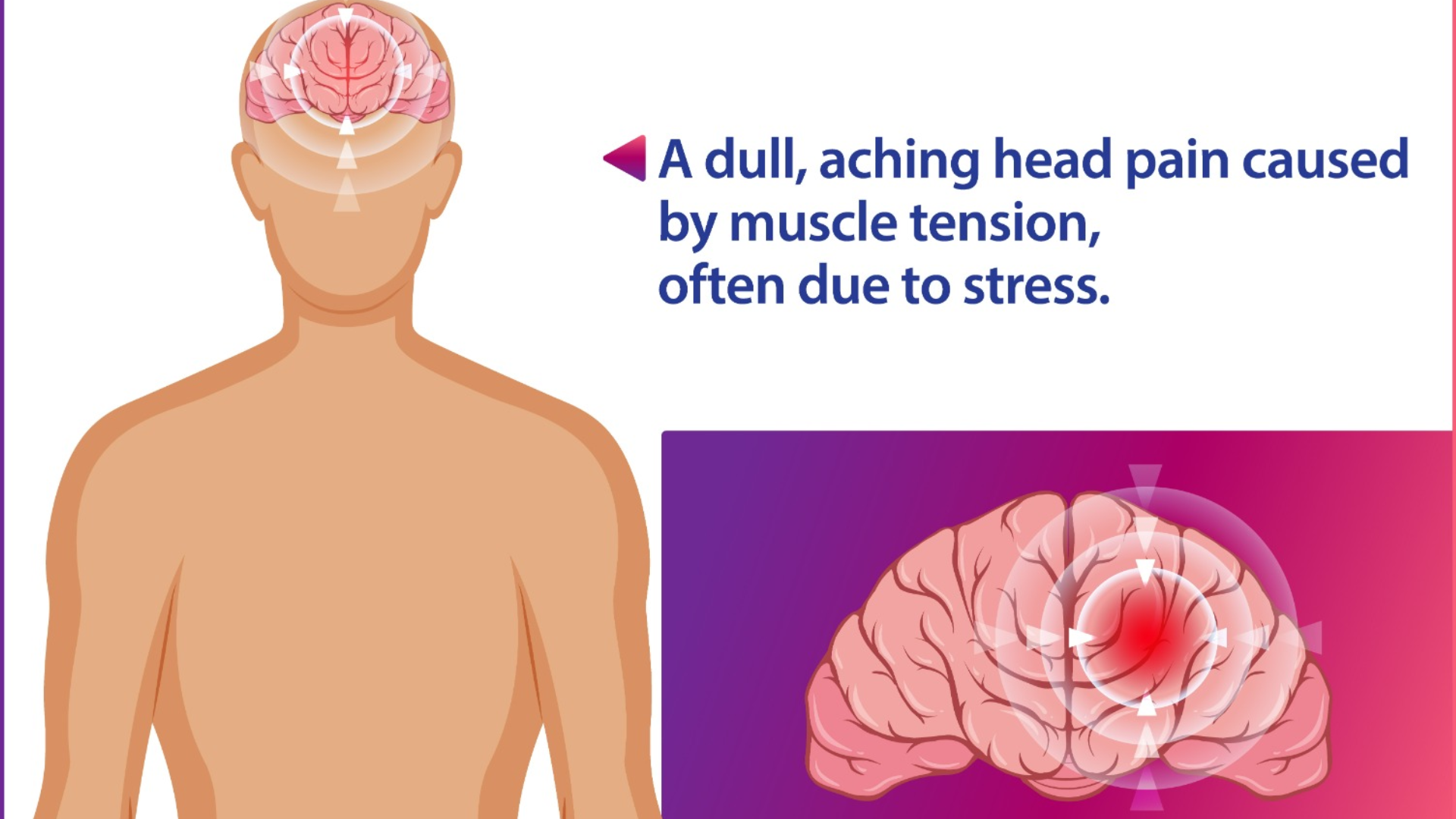 Tension Headaches