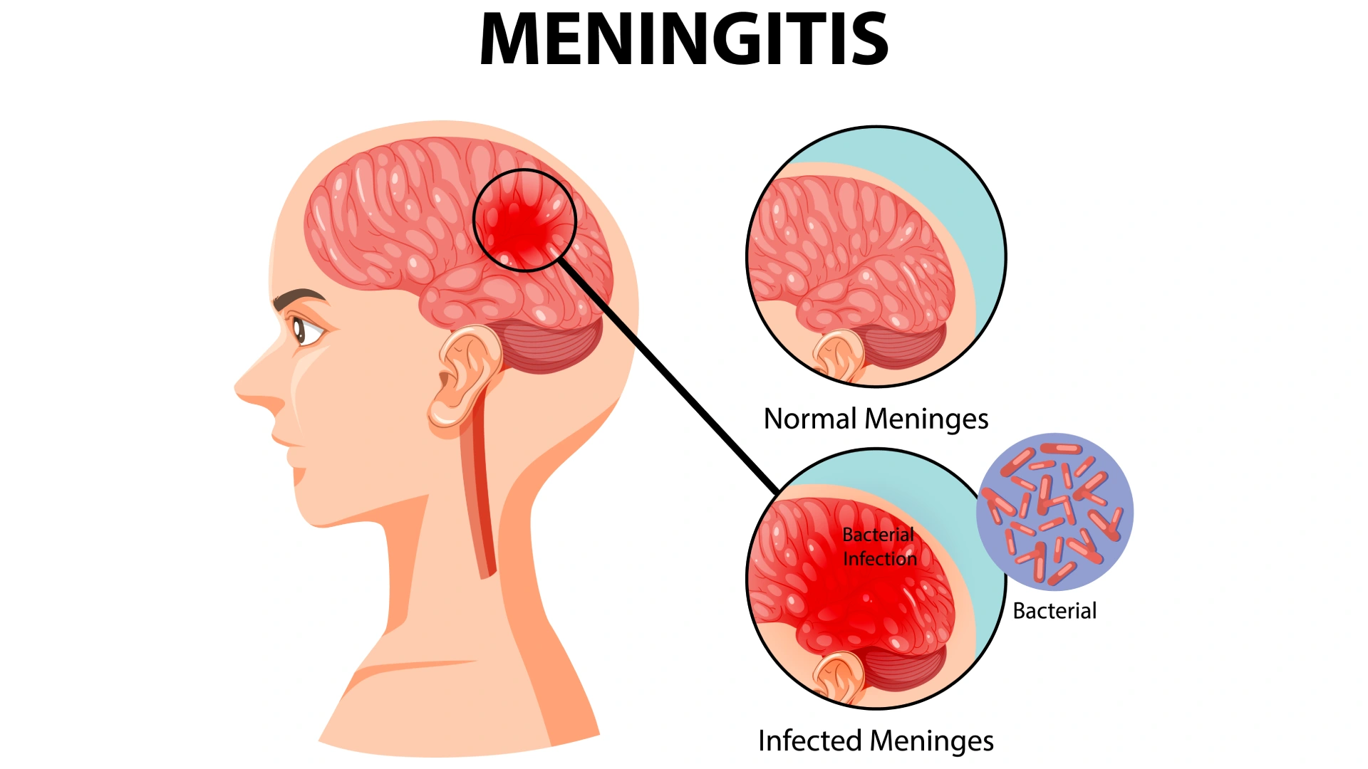 Meningitis: A Complete, Clear, and Actionable Guide