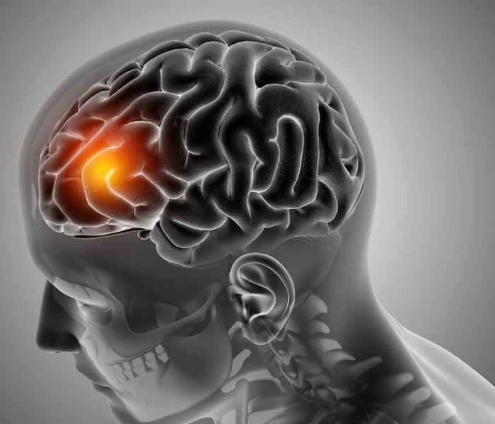 early-signs-of-brain-tumour